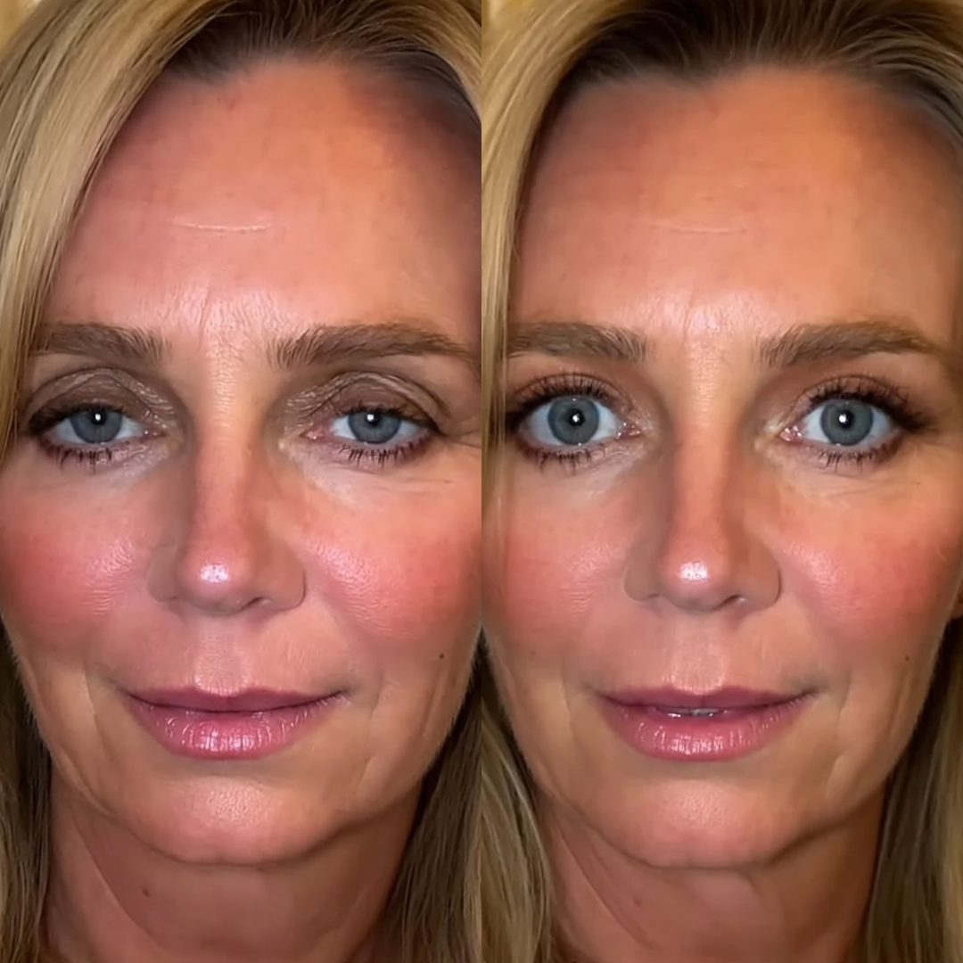 Botanique Paris customer before and after photo showing hooded upper eyelids looking visibly lifted