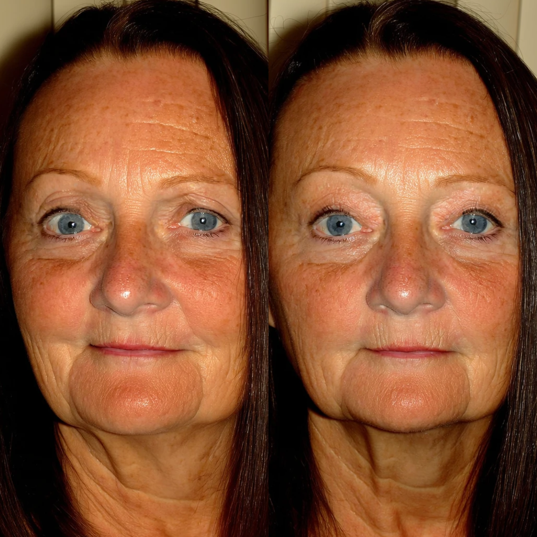 Botanique Paris customer before and after photo showing hooded upper eyelids looking visibly lifted